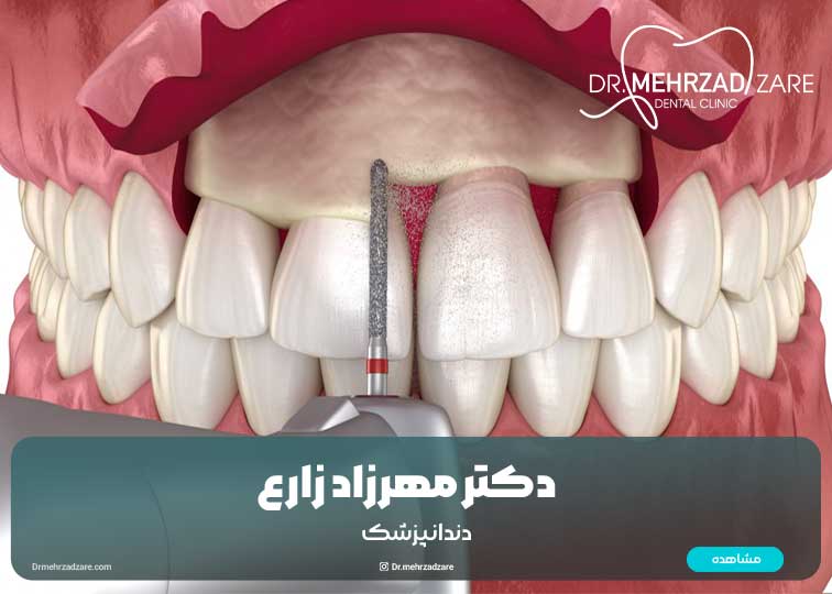 جراحی افزایش طول تاج دندان